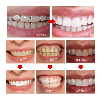 BREYLEE Albirea Dintilor Pen Dinte de Înălbitor Albi Dintii de Curățare Dentare, Igiena Orală a Elimina Placa Petele Îngrijire Orală Instrumente Dentare