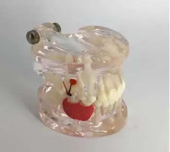 Modelul dinte Devreme morbid dentare model de dinti pentru copii transparent de Predare demonstrația